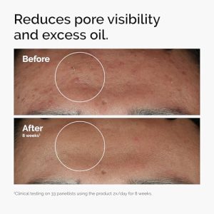 The Ordinary Niacinamide 10% + Zinc 1% Serum